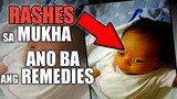 HOW TO GET RID RASHES ON BABY'S FACE (ECZEMA). ANO dapat gawin?