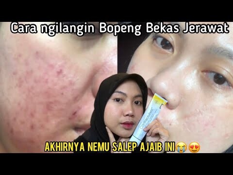 PERJUANGAN NGILANGIN BOPENG BEKAS JERAWAT | #dermapen di 🇹🇷PART 1