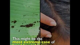 The Worst Case of Head Lice Infestation?! | Kapuso Mo, Jessica Soho