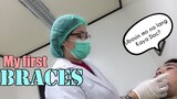 Braces Experience | First Time mag Braces