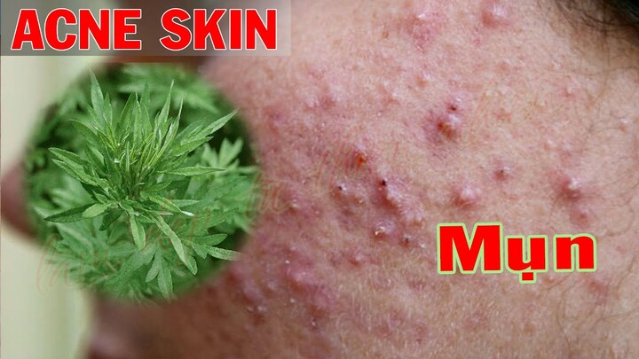 Inflammatory Acne P1 | Trị Mụn Viêm P1- SacDepSp #357