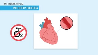 Atherosclerosis, ACS, CAD