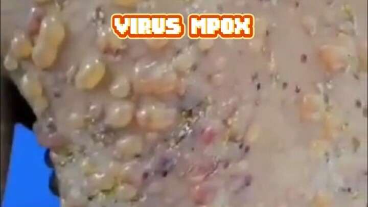 VIRUS MPOX