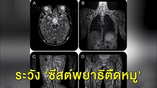 ศูนย์วิจัยโรคปรสิต เผยกินผักสดต้องระวัง 'ซีสต์พยาธิตืดหมู' หลังพบกระจายเต็มตัวคนไข้