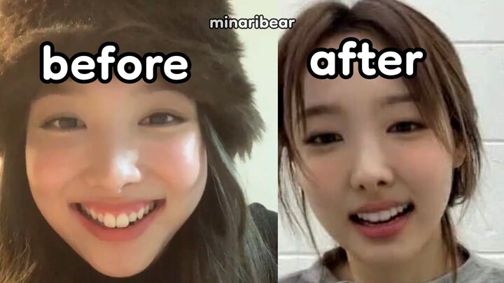 nayeon got rid of her bunny teeth??