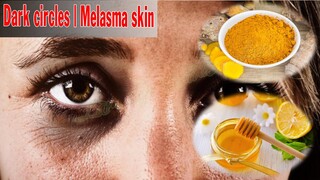 Dark circles | Melasma skin | Làm Đẹp Từ Thiên Nhiên #30