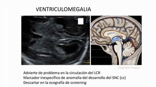 La ventriculomegalia