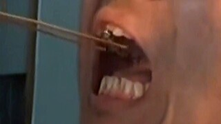 A Yunnan man had terrible bad breath. The doctor was shocked after the examination. The cause of the
