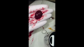 Cool blood clot removal #shorts